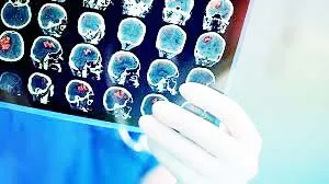 मेंदूवरही प्रभाव पाडतोय कोरोना विषाणू