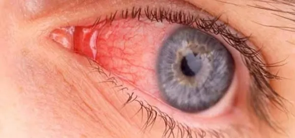 म्युकर मायकोसिसचा वेगाने फैलाव