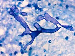 कोल्हापूर : ‘म्युकर’ने एकाचा मृत्यू, दोन नवे रूग्ण