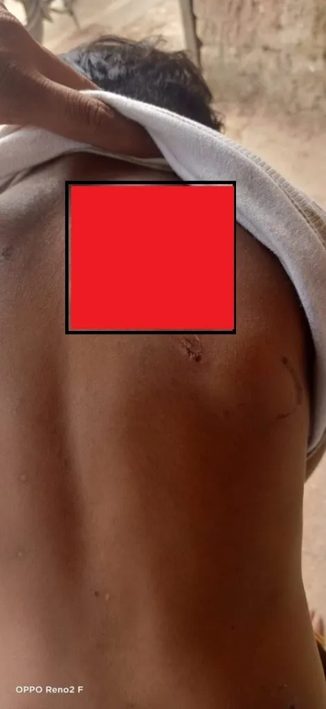 मिरज-मालगांव रस्त्यावर 20 ते 25 भटक्या कुत्र्यांचा बालिकेवर हल्ला