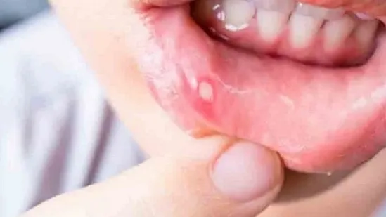 तोंड येण्याची समस्या दूर करण्यासाठी करा ‘हे’ सोपे घरगुती उपाय…