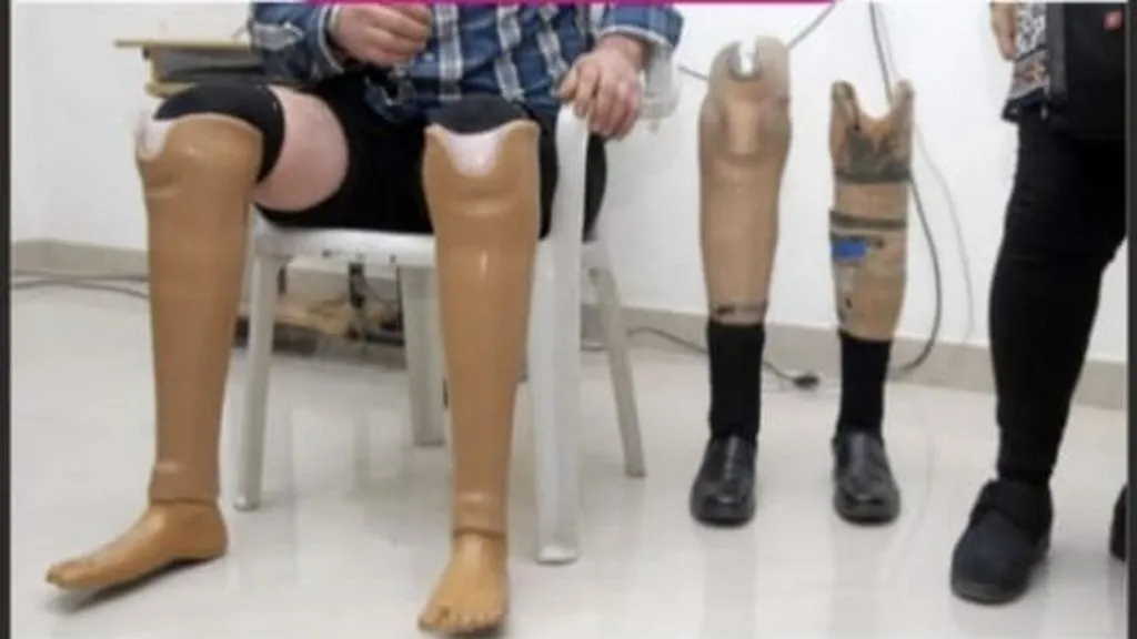 दिव्यांगांसाठी मोफत जयपुर फूट आणि तळहात