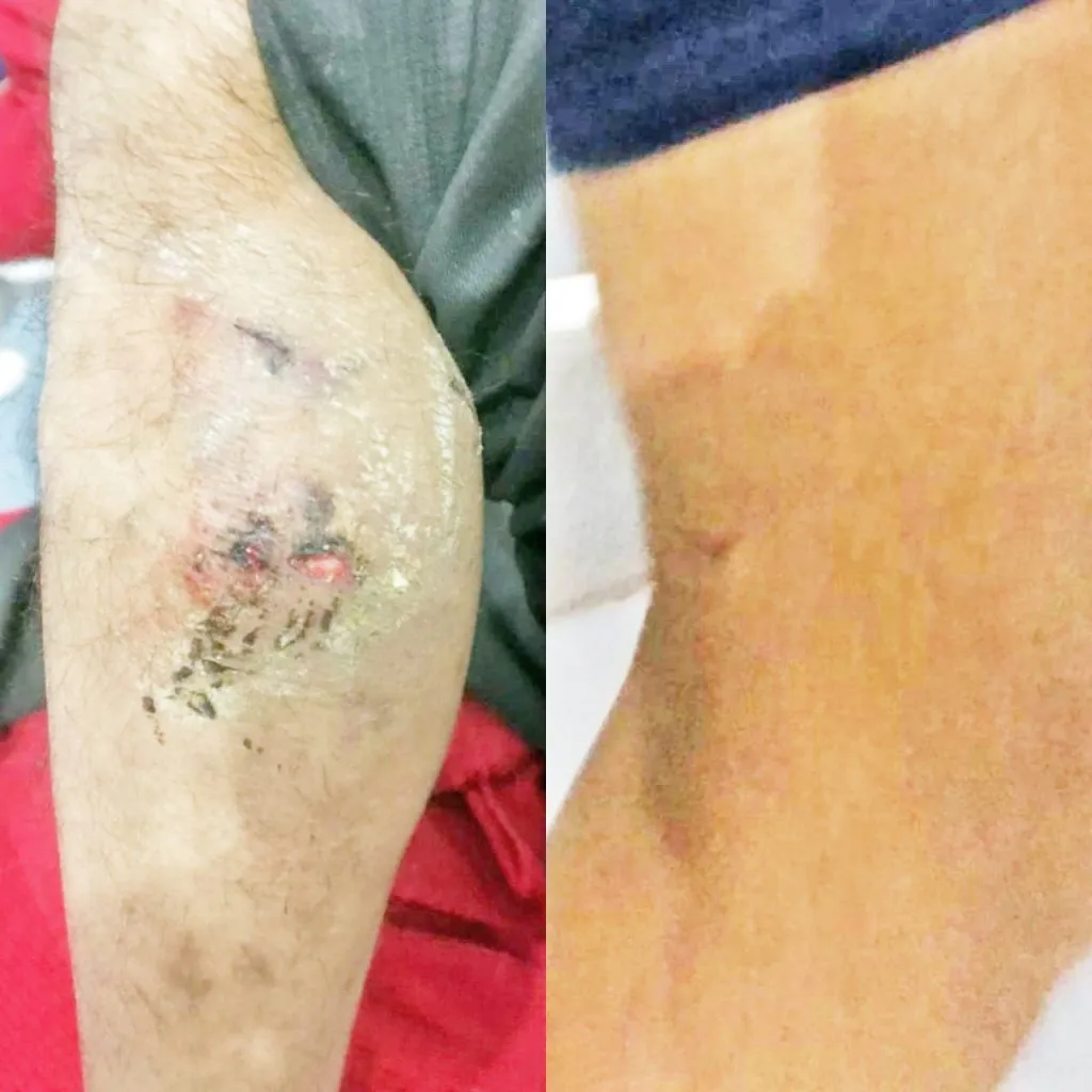 मोकाट कुत्र्याचा 11 जणांना चावा