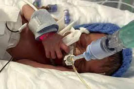 नवजाताला दुर्लभ त्वचा रोग