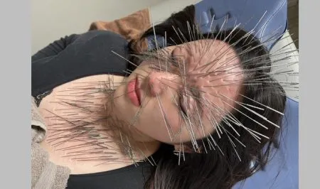 A full face acupuncture treatment