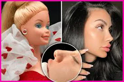 Surgery performed for 'Barbie nose'