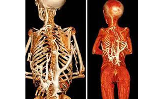 शरीरात दुसरा सांगाडा तयार करणारा आजार A disease that causes the body to produce a second skeleton