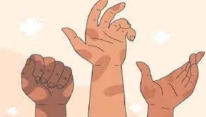 167 new leprosy patients in the district