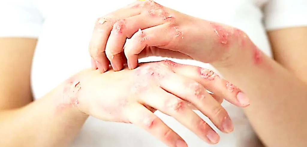 बेळगावसह विविध जिल्ह्यात शंभरहून अधिक कुष्ठरोगी More than a hundred leprosy patients in various districts including Belgaum