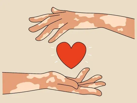 कुष्ठरोगाचा प्रसार शून्यावर शक्य Leprosy spread possible at zero