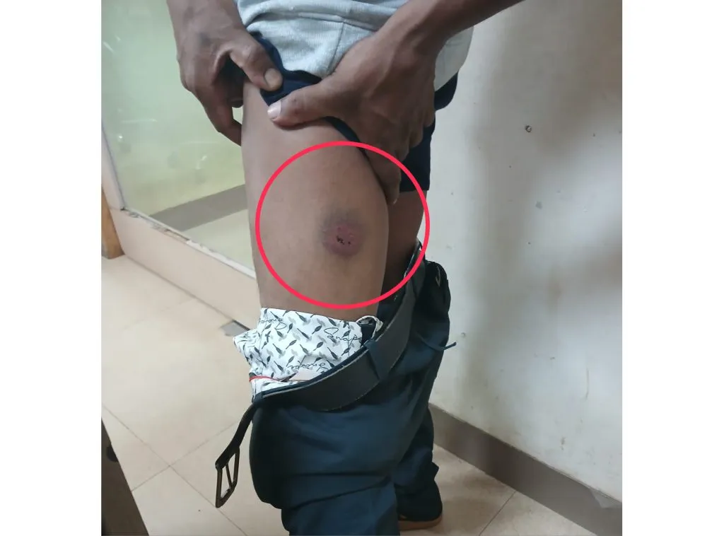 Young man bitten by stray dog ​​in Navi Gali