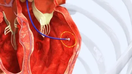 तांदळाच्या आकाराइतका पेसमेकर Pacemaker the size of a grain of rice