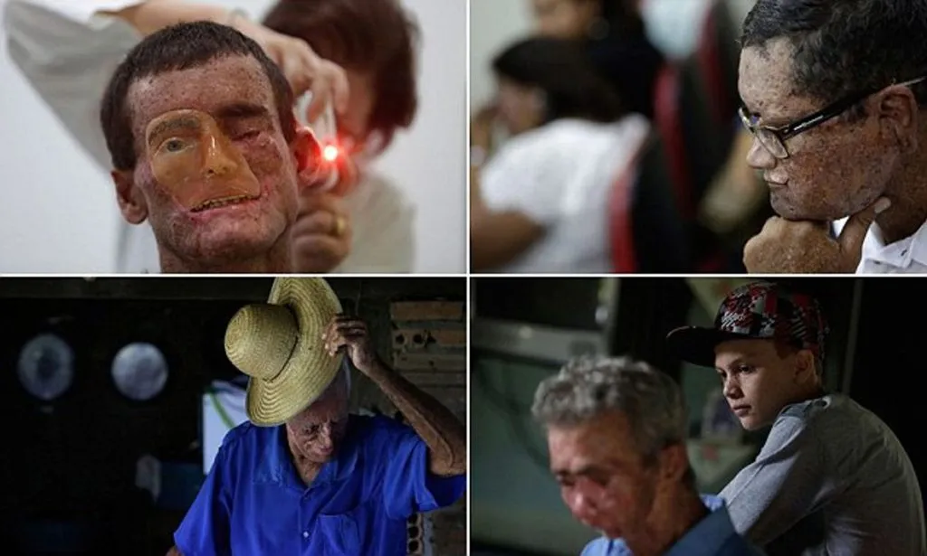 Skin starts to melt as soon as it reaches the sun.