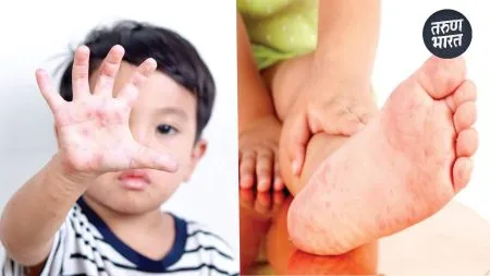 Hand Mouth Syndrome: हॅंड, माऊथ सिंड्रोम, काय आहेत लक्षण आणि कारण? mouth syndrome infection causes chickenpox blister-like rashes