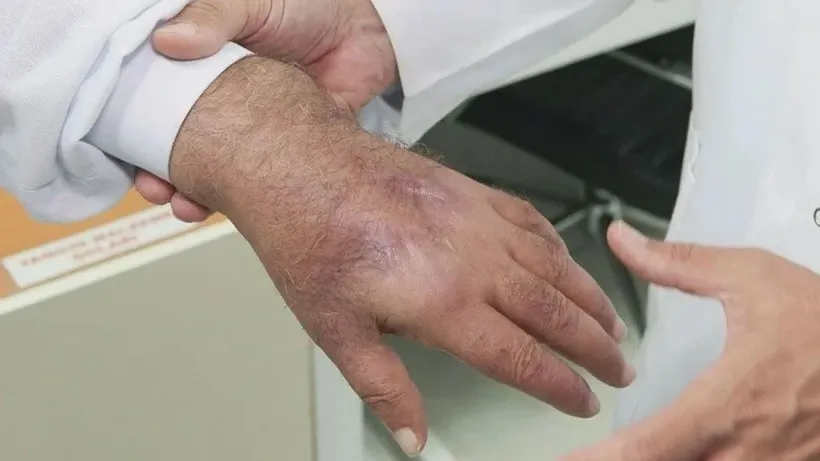 Infection caused by human bite