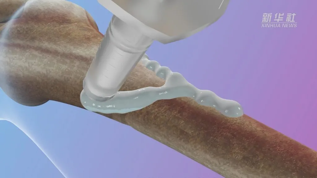 China creates first 'bone glue'